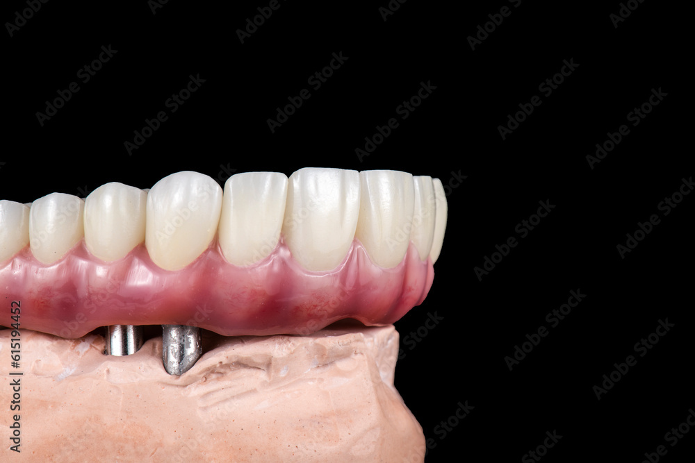 Emax ceramics on hybrid implant bridge Emax ceramics on hybrid implant bridge