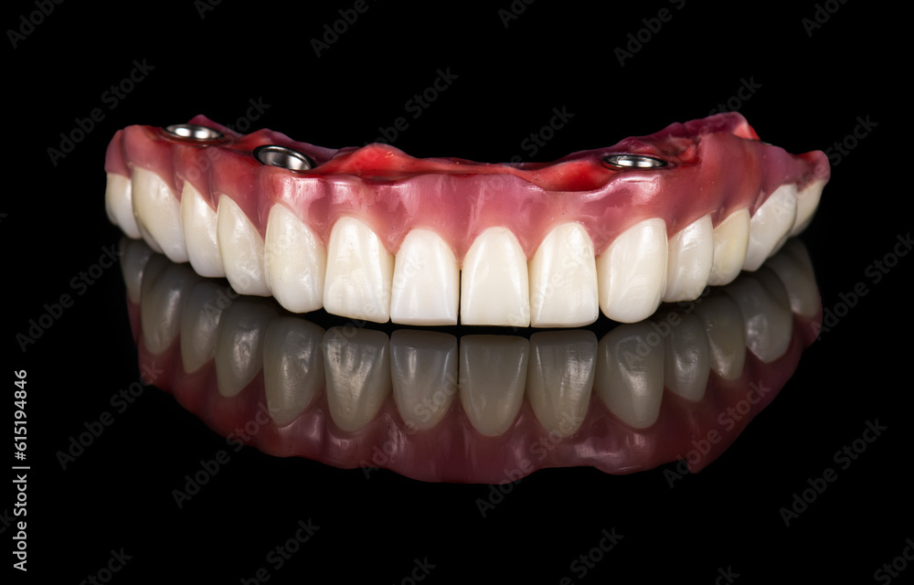 Emax ceramics on hybrid implant bridge Emax ceramics on hybrid implant bridge