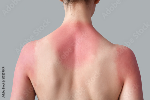 Allergic young woman with sunburned skin on grey background, back view