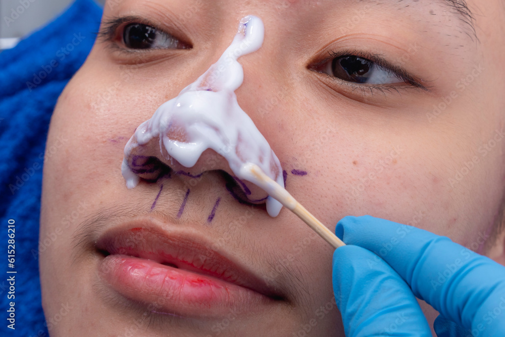 Applying topical anesthesia via a cotton swab to the nose to numb the