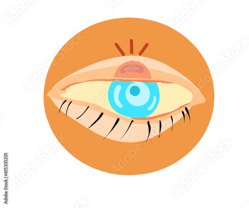 illustration vector, Human eye with swelled eyelid. Blepharitis.