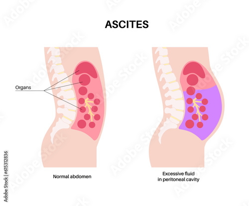 Ascites disease poster