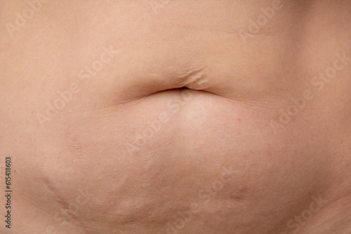 Post-pregnancy belly button altered due to an umbilical hernia or stretched skin overhanging belly button on cropped body