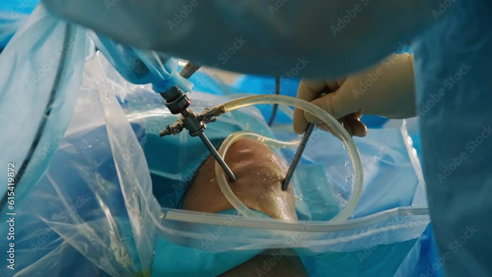 The surgeon performs endoscopic manipulation on the kneecap. The doctor