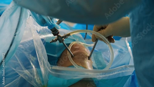 The surgeon performs endoscopic manipulation on the kneecap. The doctor does arthroscopic surgery on the knee, joint in the operating room using modern arthroscopic tools.  photo