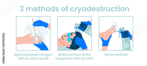 Methods of cryodestruction. Application of liquid nitrogen with a cotton swab. Direct contact of the cryoprobe with the skin. Spray method. Flat vector illustration. photo