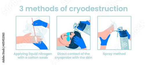 Methods of cryodestruction. Application of liquid nitrogen with a cotton swab. Direct contact of the cryoprobe with the skin. Spray method. Flat vector illustration.