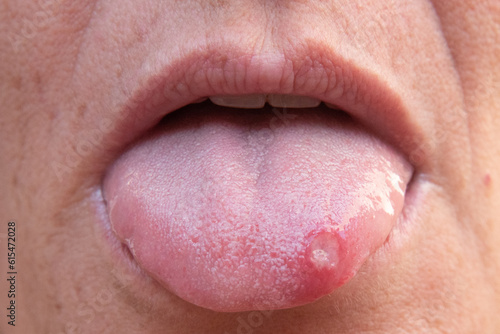 canker sore on a person's tongue, upset stomach photo