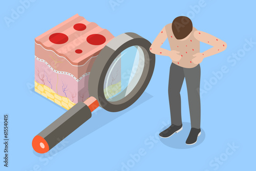 3D Isometric Flat Vector Conceptual Illustration of Chickenpox, Red Rash