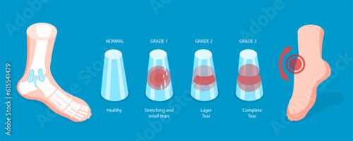 3D Isometric Flat Vector Conceptual Illustration of Grades Of Sprain, Ankle Problem
