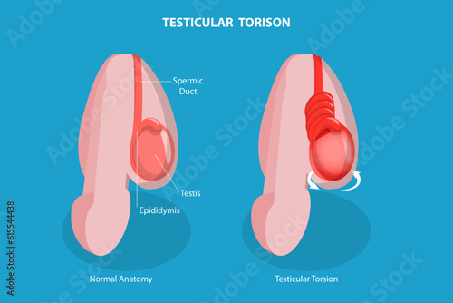 3D Isometric Flat Vector Conceptual Illustration of Testicular Torison, Male Reproductive System Disorder