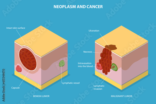 3D Isometric Flat Vector Conceptual Illustration of Neoplasm And Cancer, Tumor Development