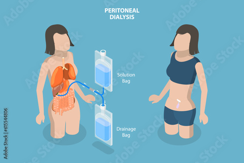 3D Isometric Flat Vector Conceptual Illustration of Peritoneal Dialysis, Explanation Diagram