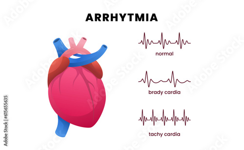 Cardiac disease arrhythmia with a heart and pulse ECG, showcasing normal heart rhythm, bradycardia or slow heart rate, and tachycardia or fast heart rate