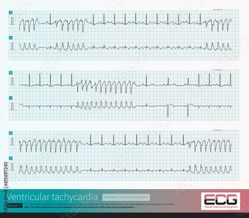 An 11 month old male infant was clinically diagnosed with cytomegalovirus myocarditis. The child repeatedly experienced ventricular tachycardia during hospitalization.