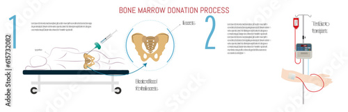 Process of bone marrow transplantation by means of an iliac crest puncture.