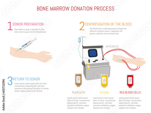 Process of bone marrow transplantation by means of apheresis 