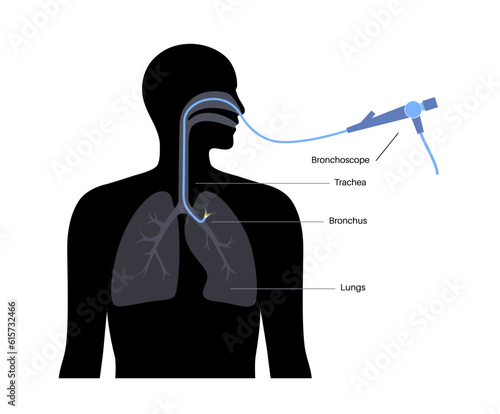 Bronchoscopy procedure concept