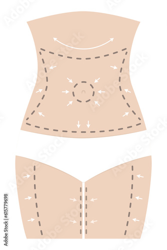 Female body figure with white underwear, arrows, marks, surgical dotted lines for surgical surgery.
Concept Fat loss, liposuction, cellulite removal, skin lifting.
Editable color vector illustration