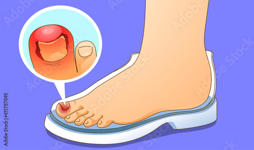 Fingers with ingrown toenail, vector illustration 