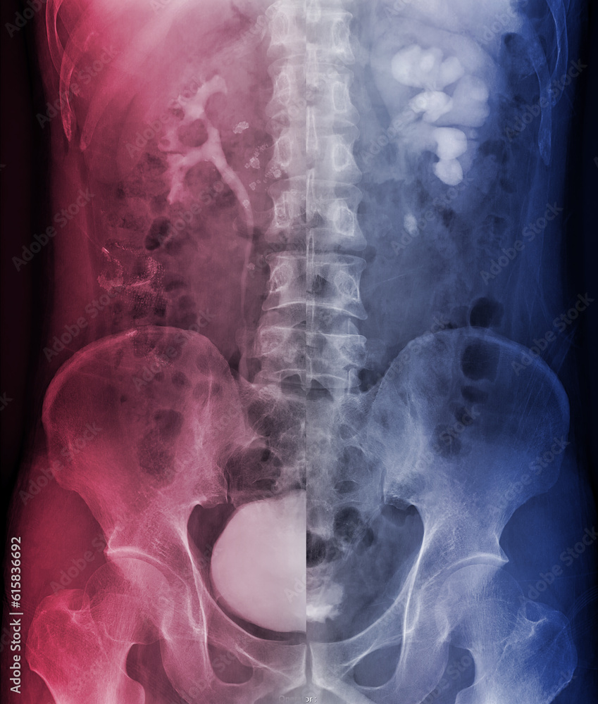  Intravenous pyelogram or I.V.P is an X-ray exam of urinary tract after injection contrast media agent  compare full bladder and post void. - obrazy, fototapety, plakaty 