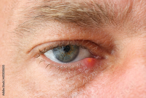 close up man's eye with stye symptoms. Stye (hordeolum) disease on eye of a caucasian man showing outside of lower eyelid. `the  swelling eye can caused by virus or bacteria infections.