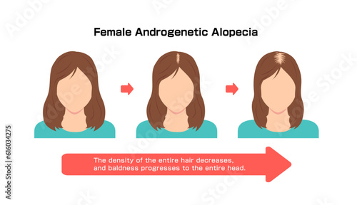 Progress of Female Androgenetic Alopecia. Vector illustration