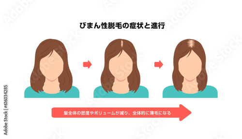 Progress of Female Androgenetic Alopecia. Vector illustration