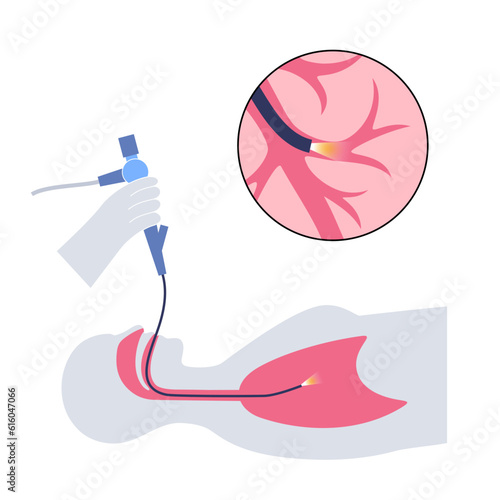 Bronchoscopy procedure concept