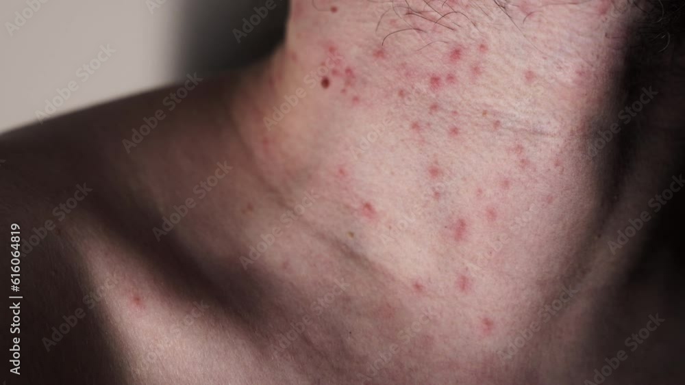 Pimples on the body, neck. Possible insect bites, allergic reaction. Severe itching. Closeup of man's chin. Pimples on the body, neck. Possible insect bites, allergic reaction. Severe itching. Closeup of man's chin.
