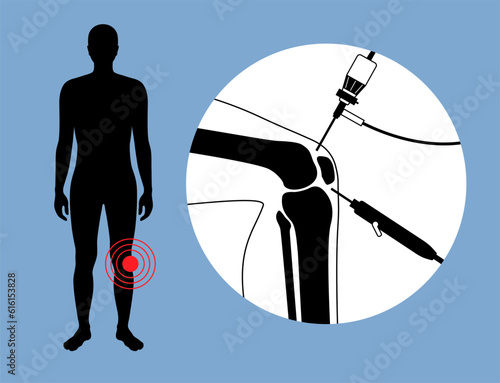 Knee joint arthroscopy