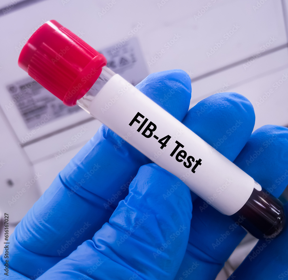 Blood sample for FIB-4 (Fibrosis-4) test, diagnosis of liver disease ...
