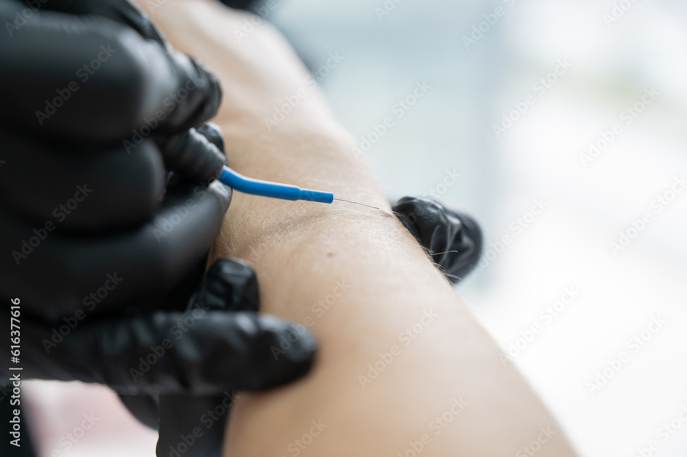 Dermatologist removes a mole on a patient's arm using an electrocoagulator. 