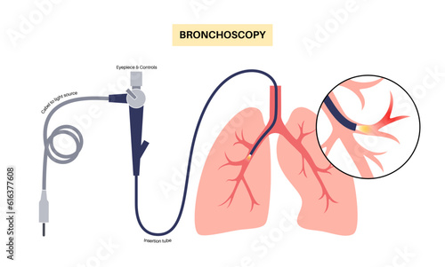 Bronchoscopy procedure concept