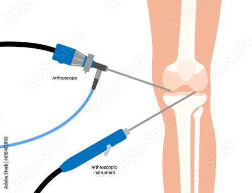 Knee joint arthroscopy photo