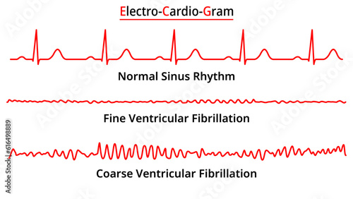 Set of ECG Common Abnormalities - Fine vs Coarse Ventricular Fibrillation (VF) - Normal Sinus Rhythm - Electrocardiography Vector Medical Illustration