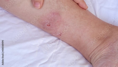 person scratches psoriatic rashes on skin with hand with chronic dermatitis, wound on painful female leg, medical concept, chronic condition, dermatological disorder, skin problem, affected area
