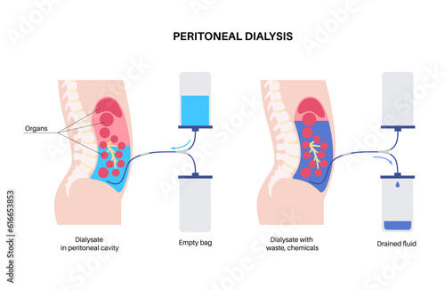 Peritoneal dialysis concept