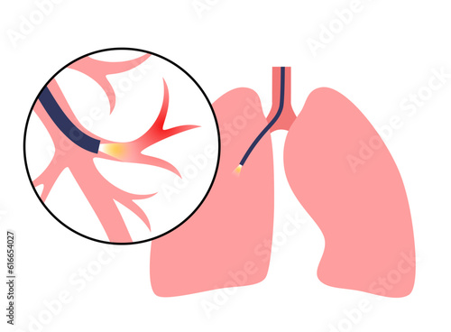Bronchoscopy procedure concept