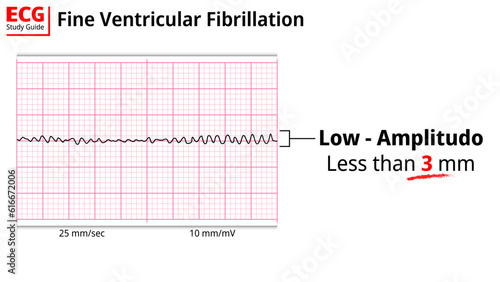 ECG Fine Ventricular Fibrillation - Electrocardiogram Study Guide - Medical Vector Illustration