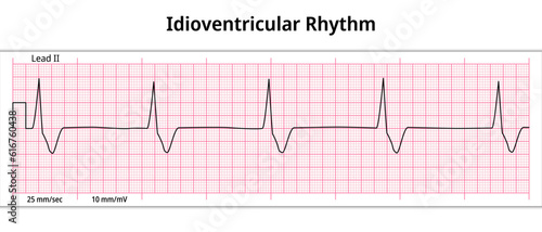 ECG Idioventricular Rhythm - 8 Second ECG Paper - Electrocardiography Medical Vector Illustration