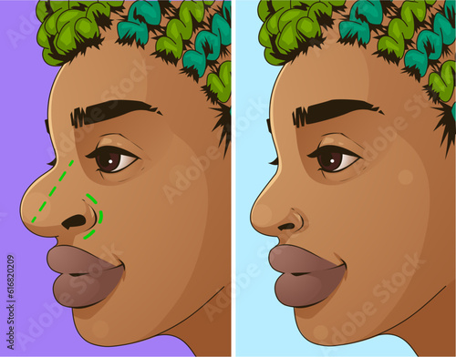 Rhinoplasty, before and after. Correction the shape of the human's nose. Medical illustration. Vector illustration.