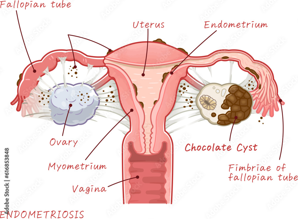 ENDOMETRIOSIS、Chocolate Cyst、ovary、uterus、illustration Stock Vector