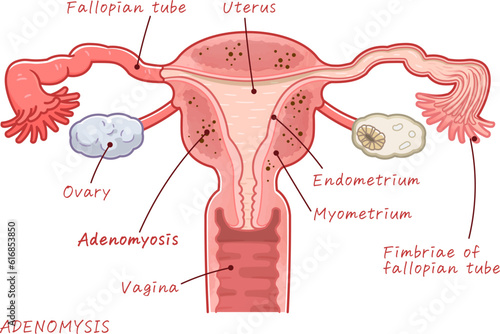 adenomyosis of uterus、ovary、uterus、illustration