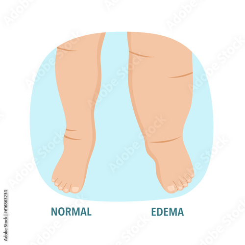 Edema foot swollen leg disease in flat design.