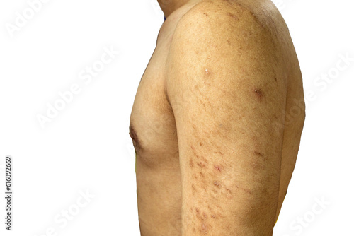 Acne scars on arms © phurimart