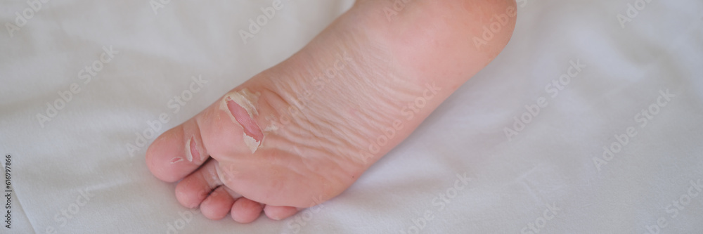 Heel of child with flaky skin after burn or injury closeup. Consequences after transferred enterovirus infection and syndrome hand foot mouth concept Heel of child with flaky skin after burn or injury closeup. Consequences after transferred enterovirus infection and syndrome hand foot mouth concept