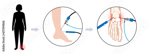 Ankle arthroscopy poster