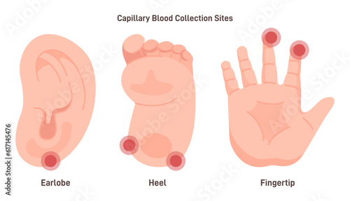 Capillary blood sampling sites. Collection of capillary blood from