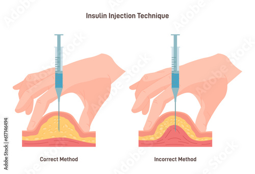 Insulin injection technique. Correct and incorrect way. Cross-section